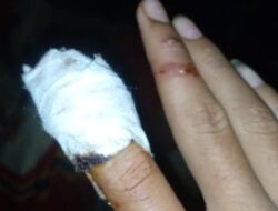 Jari Siswa Hampir Putus Karena Kecelakaan Kerja Di Sekolah, UPT SMP 10 Parsingguran Ogah Tanggung Jawab