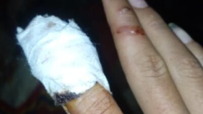 Jari Siswa Hampir Putus Karena Kecelakaan Kerja Di Sekolah, UPT SMP 10 Parsingguran Ogah Tanggung Jawab
